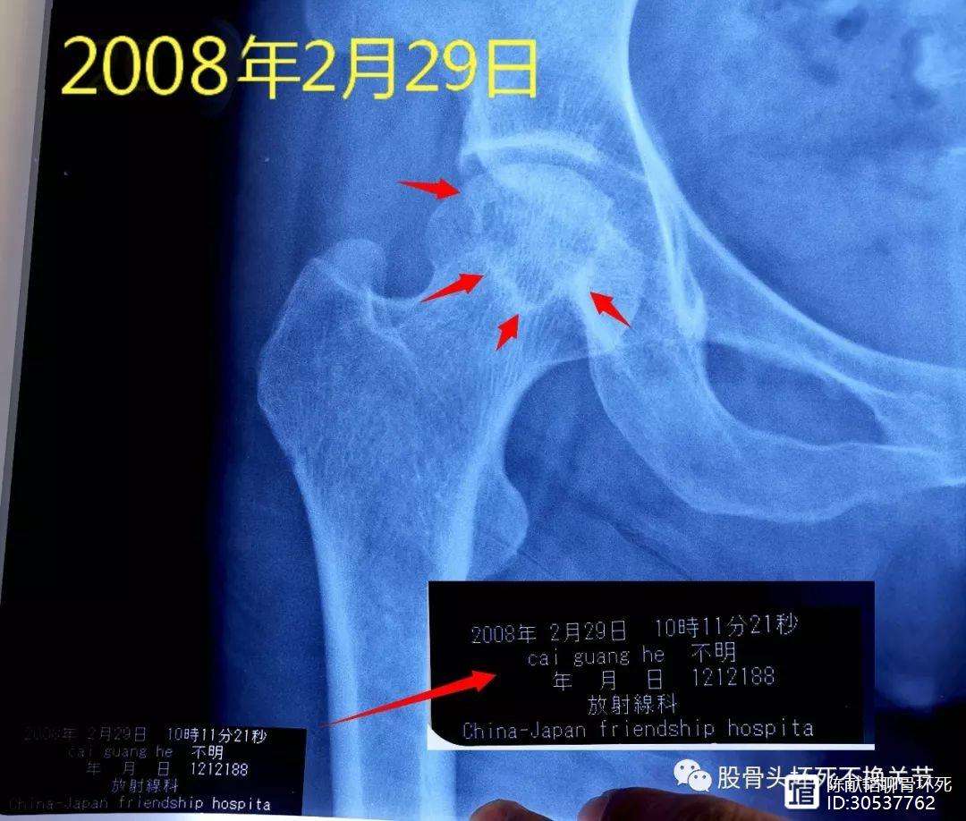 宿迁人工骨头医保报销多少(人工骨头医保报销多少比例)