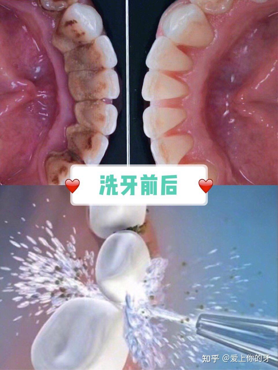 宿迁洗牙可以用医保吗(洗牙可以用医保吗,报销比例多少)